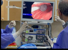 خارج کردن قاشق غذاخوری از معده بیمار گیلانی بدون عمل جراحی