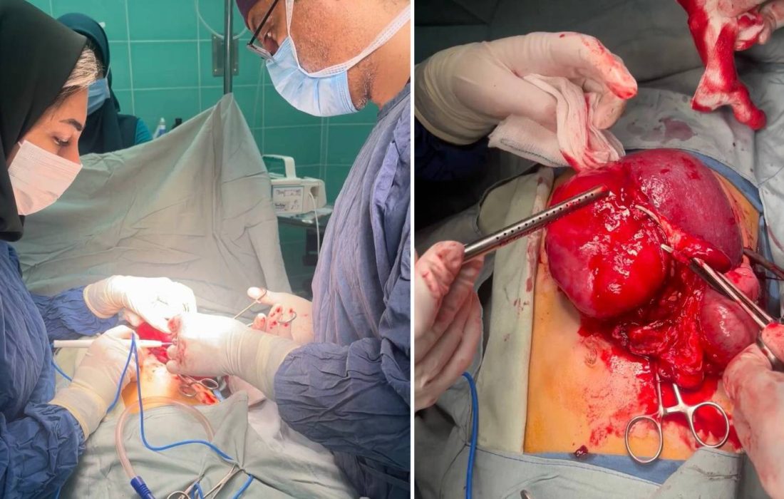 خارج کردن تومور شکمی از بدن کودک ۱۰ساله در مرکز آموزشی و درمانی ۱۷ شهریور رشت