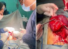 خارج کردن تومور شکمی از بدن کودک ۱۰ساله در مرکز آموزشی و درمانی ۱۷ شهریور رشت