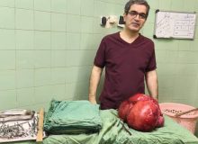 تلاش موفق تیم جراحی بیمارستان شهید انصاری رودسر: خارج کردن توده سنگین از شکم بیمار پس از سال‌ها درد