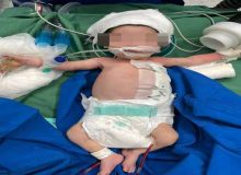 انجام موفقیت‌آمیز عمل جراحی کیست مادرزادی جدار شکم بر روی نوزاد ۱۱ روزه در مرکز آموزشی و درمانی ۱۷ شهریور