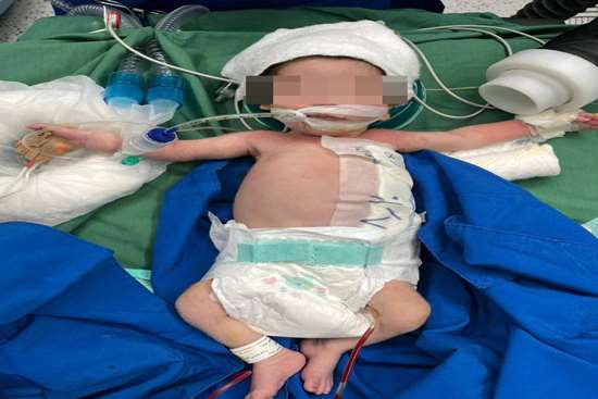 انجام موفقیتآمیز عمل جراحی کیست مادرزادی جدار شکم بر روی نوزاد ۱۱ روزه در مرکز آموزشی و درمانی ۱۷ شهریور